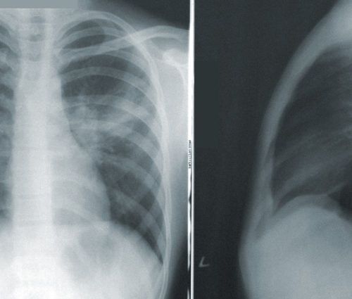 X - rays of the chest and ribs.